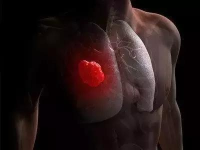 今生的肺癌与前世有关吗,晚期肺癌的早期症状及表现