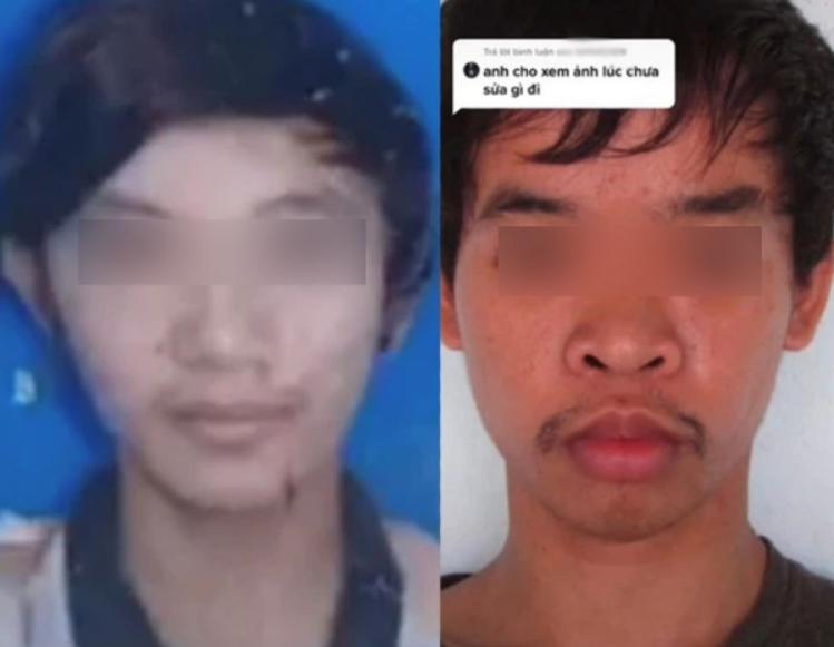 越南丑男整容变帅,越南小伙儿整容成功