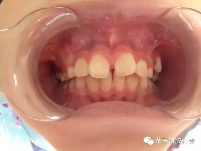4岁小孩儿牙缝大正常吗,小朋友牙缝大正常吗