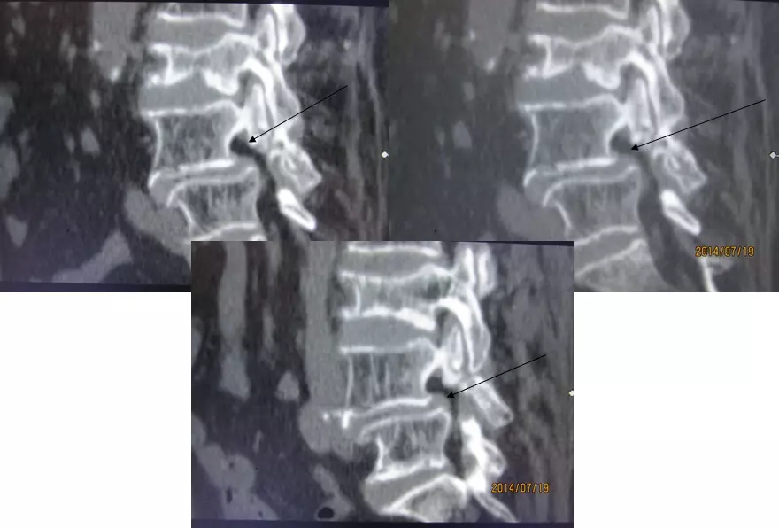 颈椎腰椎疾病ct及mri诊断,腰椎ct可以发现肠部病变吗