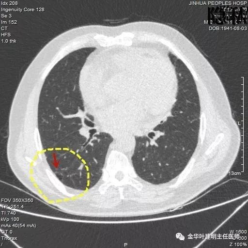 警惕-会是简单的肺大泡吗？