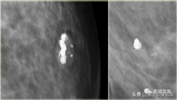 乳腺钙化怎么区分良性和恶性,乳腺钙化的诊断与分级