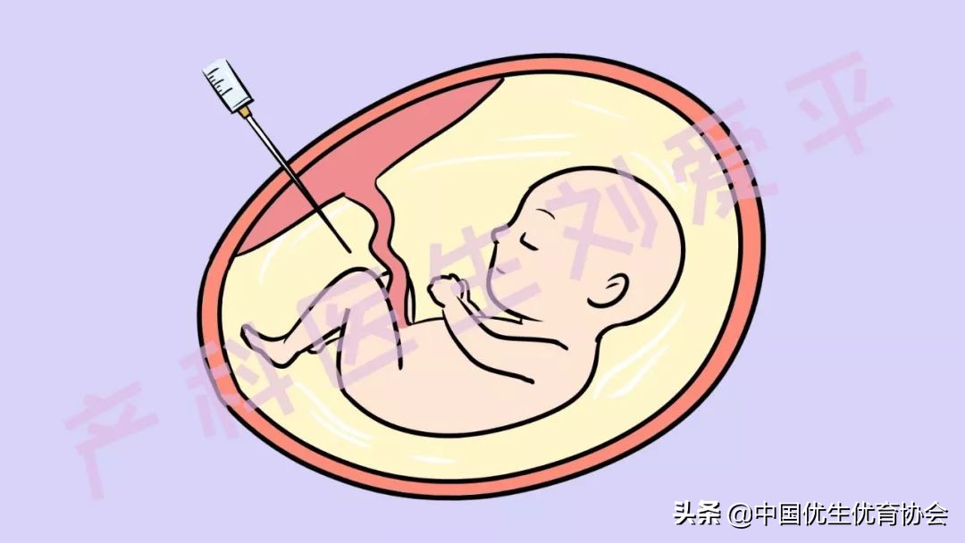 羊水穿刺抽妈妈的血做什么的,脐静脉穿刺和羊水穿刺谁更准