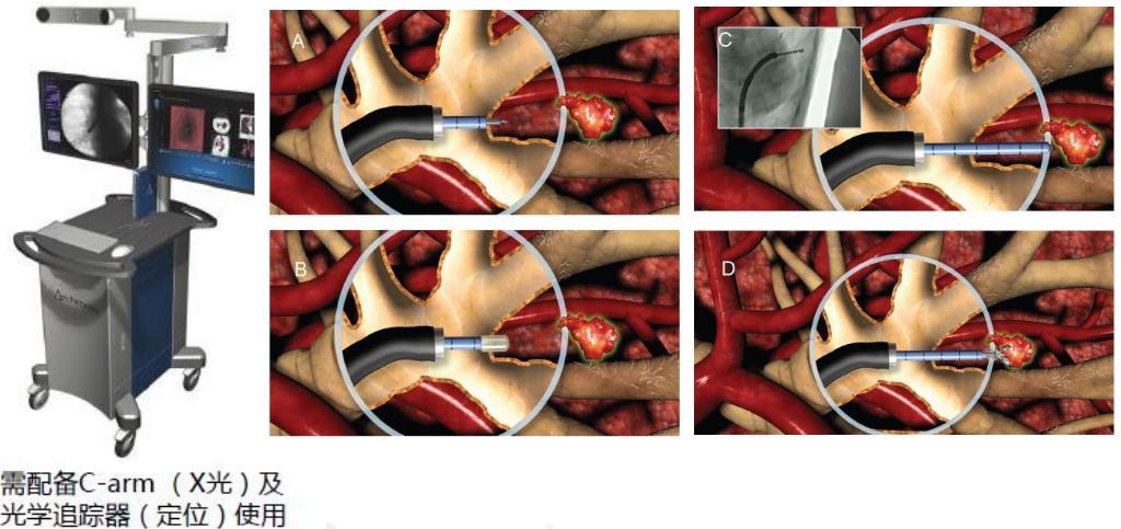 孙加源门诊,治疗肺癌的新技术新手段