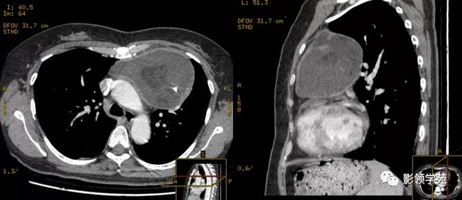 纵隔和肾上腺恶性肿瘤,纵隔性肿瘤位置图