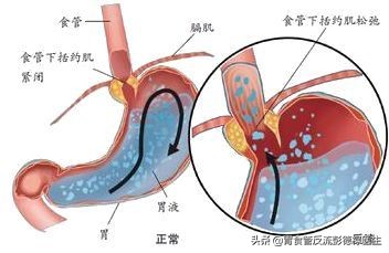 咽喉不舒服感觉要感冒,喉咙堵着一口气是胃的问题吗
