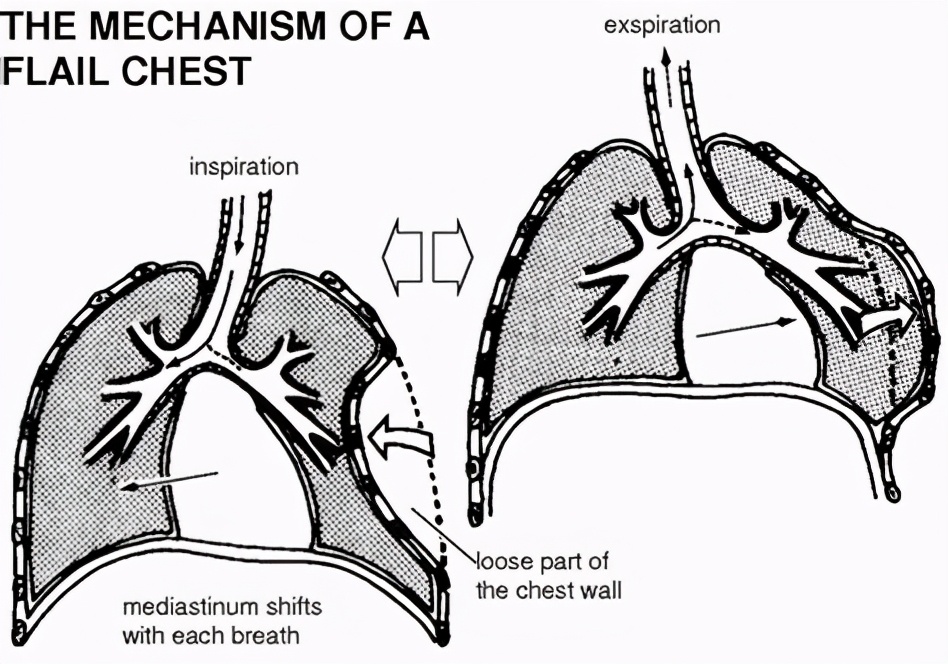 摔了一跤肋骨骨裂碍事吗,摔折八根肋骨治好了会留后遗症吗