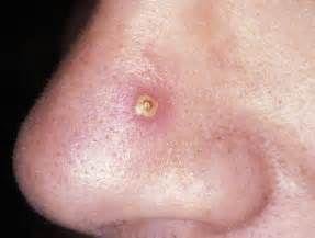 毛囊炎疖和痈的区别,毛囊炎的症状与疣区别是什么样的