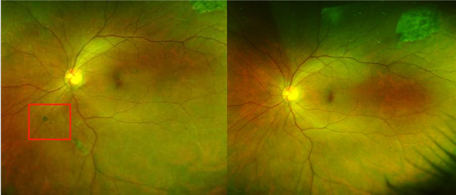 眼前出现一块飞蚊症,眼前总有小黑点在飞用什么眼药水