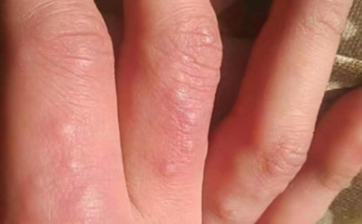 脚底板和脚趾之间长了个水泡很痒,手指缝脚趾缝有小疙瘩痒