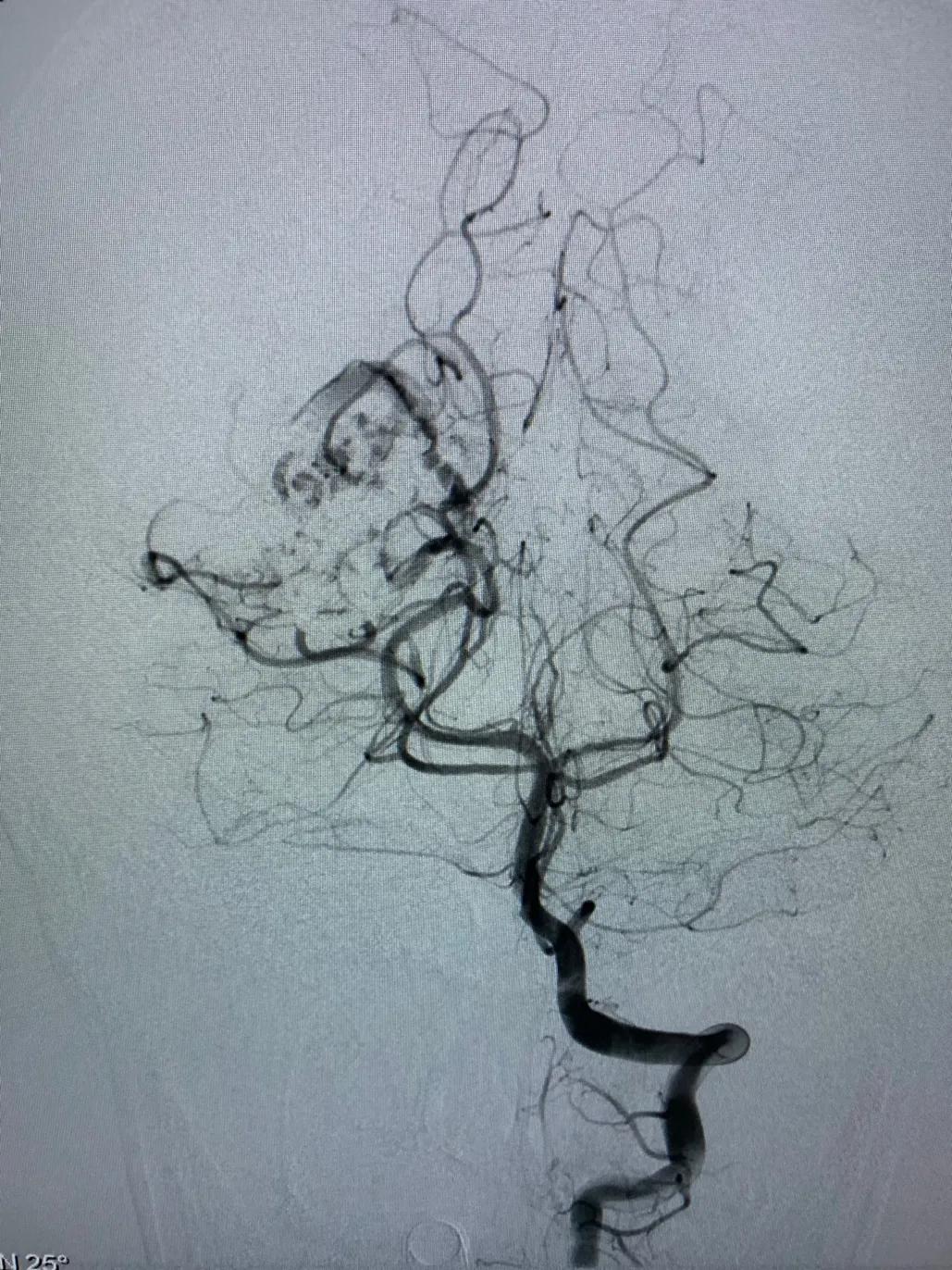 脑动静脉畸形介入栓塞手术的风险,介入栓塞技术在脑avm治疗中的作用