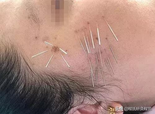 祛痘咨询科普,祛痘咨询中医调理