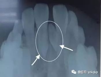 4岁小孩儿牙缝大正常吗,小朋友牙缝大正常吗