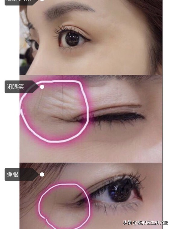 瘦脸针注意事项和禁忌,打瘦脸针前要吃饭