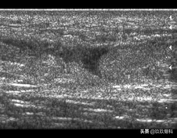 跟腱断裂的确诊方法,超详细跟腱断裂的诊断与治疗