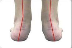 有扁平足、足弓塌陷的你要注意“胫骨后肌腱失能”