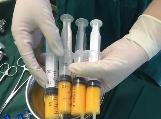 泪沟自体脂肪填充永久,自体脂肪填充太阳穴可以永久吗