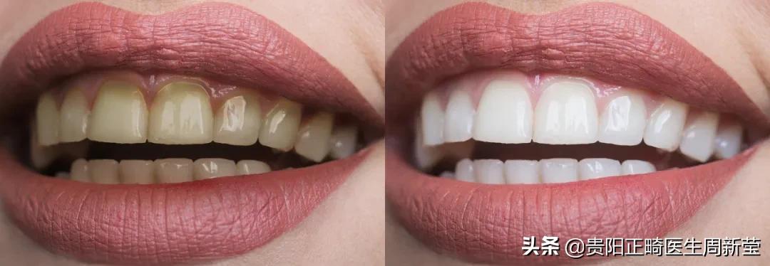 天天刷牙牙齿黑斑点,天天刷牙还是黄牙正确方法请收好