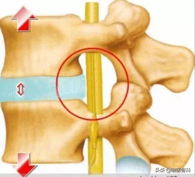 腰椎间盘突出手术后多久可以跑步,患了腰椎间盘突出还能跑步吗