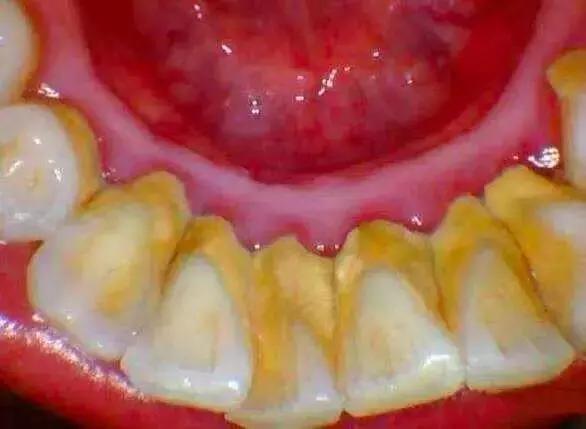 为什么中国人逃不过「牙齿掉光」的宿命?