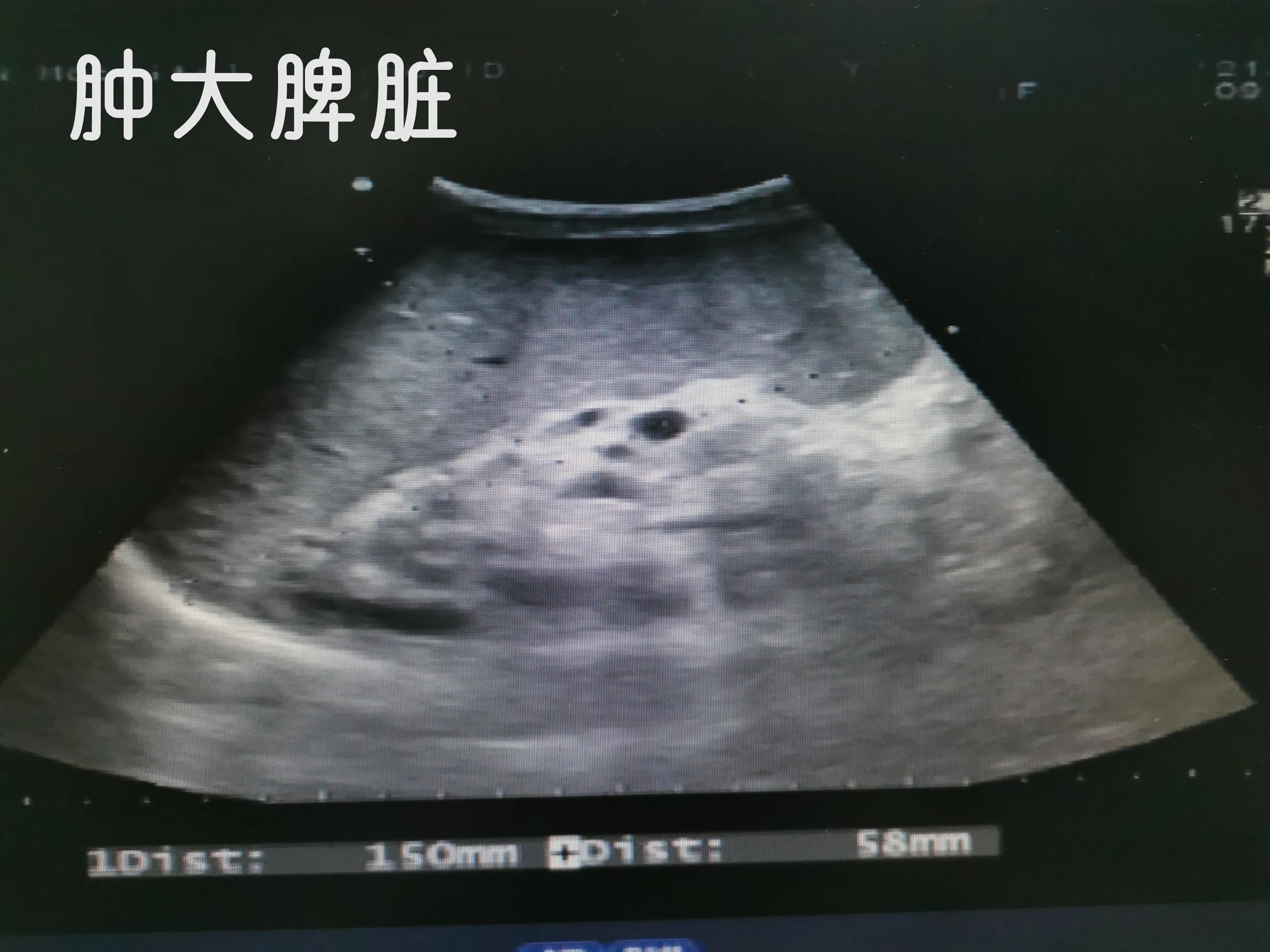 乙肝肝硬化和丙肝肝硬化的区别,乙肝肝硬化肝部占位是肝癌吗