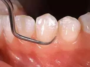 为什么洗牙价格相差这么大,普通洗牙和舒适洗牙有什么区别