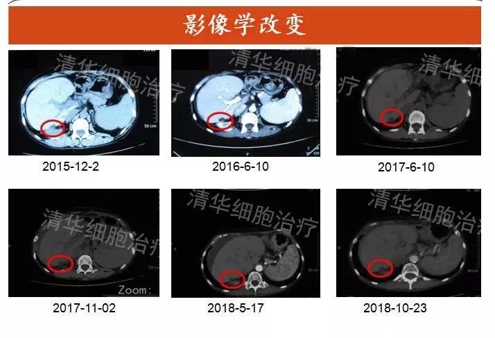 nkt治疗对什么肿瘤有效,nkt治疗适合哪种癌症