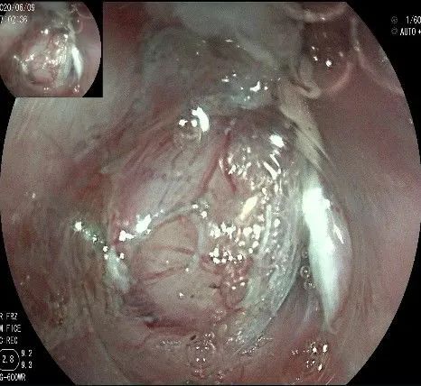 贲门隆起性病变影像,贲门溃疡隆起性病变