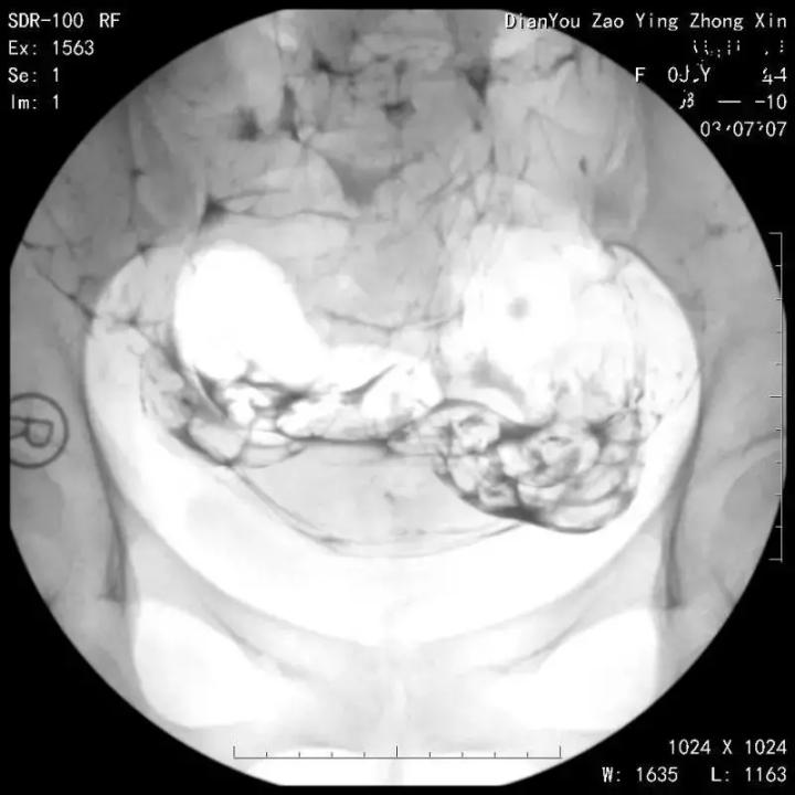 做输卵管造影，碘水好还是碘油好？