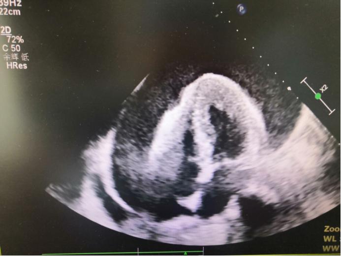 肾积液心包积液,肾移植有积液怎么回事