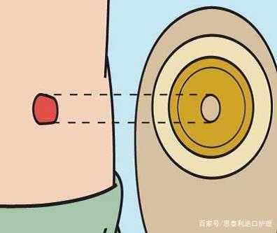 结肠癌术后引流管疼痛怎么办,结肠癌术后伤口流脓怎么办