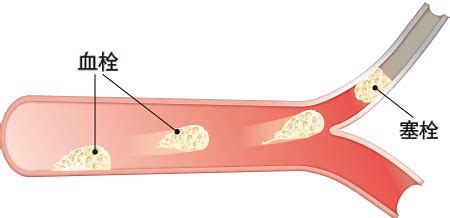血栓脑干堵了什么症状,血栓堵在咽喉有什么症状