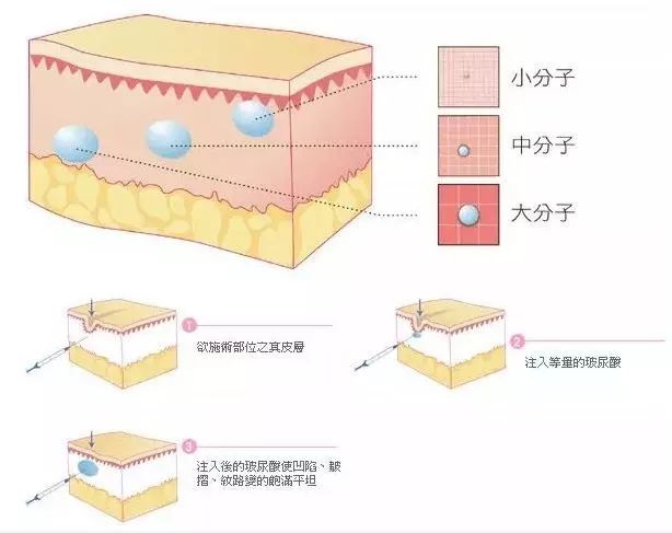 美颜都遮不住的法令纹该怎么回答,滤镜才是法令纹的天敌