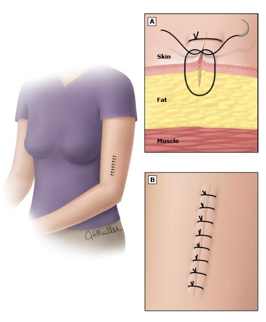手术刀口上有订书钉怎么回事,手术伤口为什么要用订书针缝线