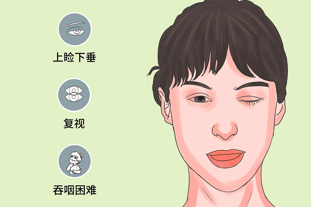 全身型重症肌无力预后,胆碱酯酶治疗重症肌无力的原理