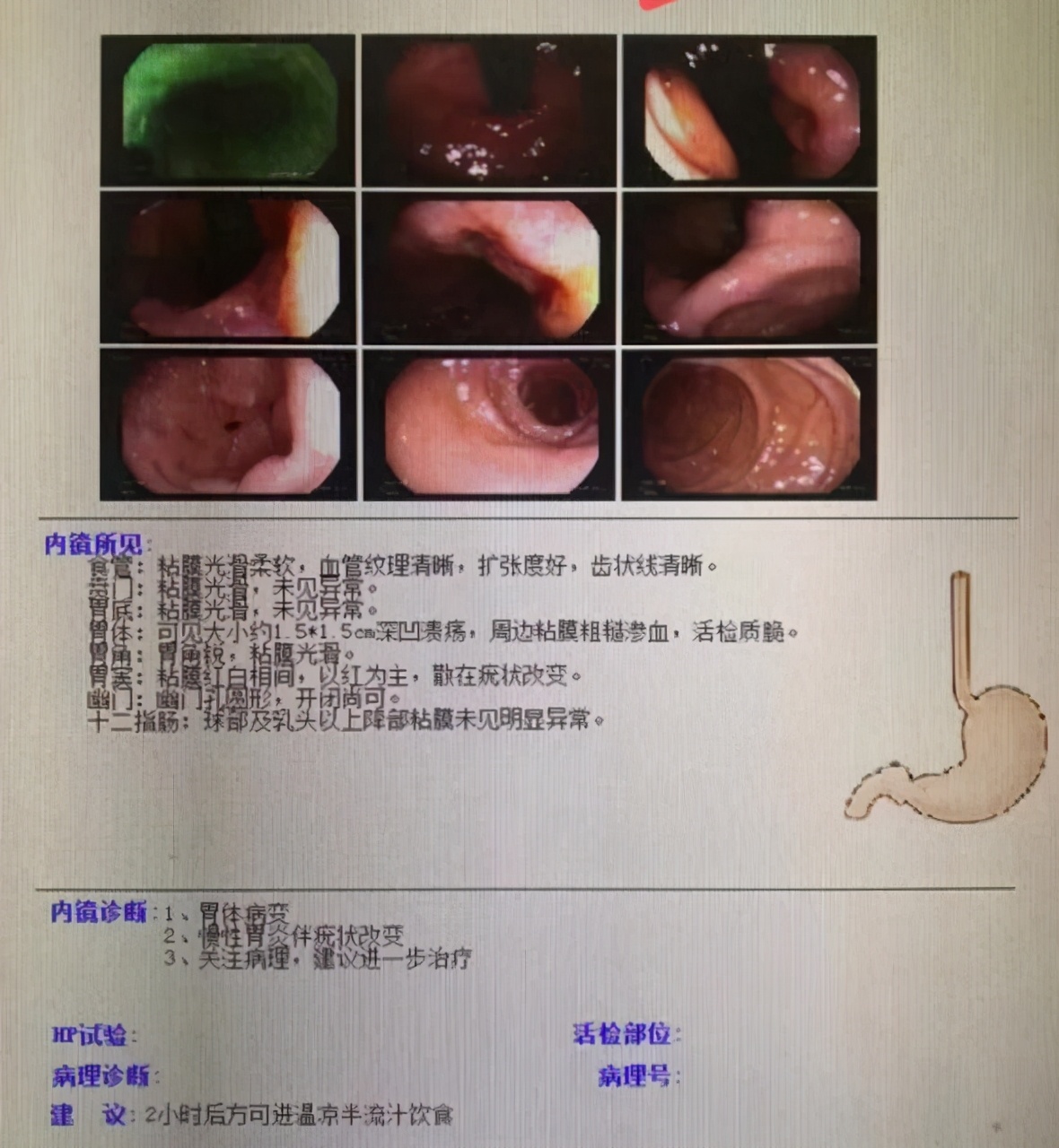 胃体溃疡、糜烂，患者不配合医生治疗，几个月后恶化成早癌