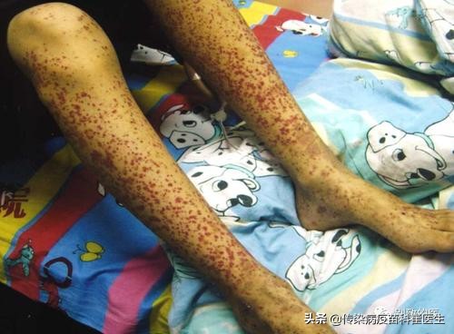 秋冬季怎样预防过敏性紫癜复发,过敏性紫癜什么情况下可以自愈