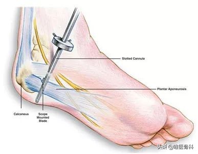 脚跟疼是足底筋膜炎么,足底筋膜炎是足底痛还是足跟痛