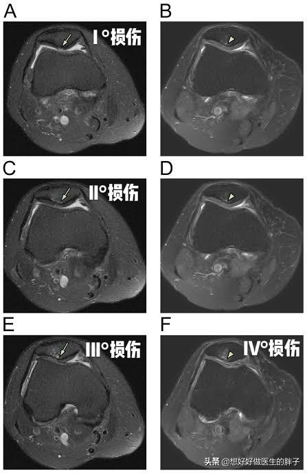 骑自行车膝盖有摩擦的感觉,骑自行车膝盖内侧疼是怎么回事