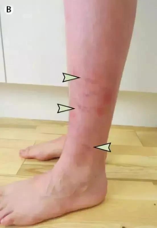 你买的药膏正规吗？无药物批号、违规添加激素，让病情加重的「皮肤神药」仍在畅销！