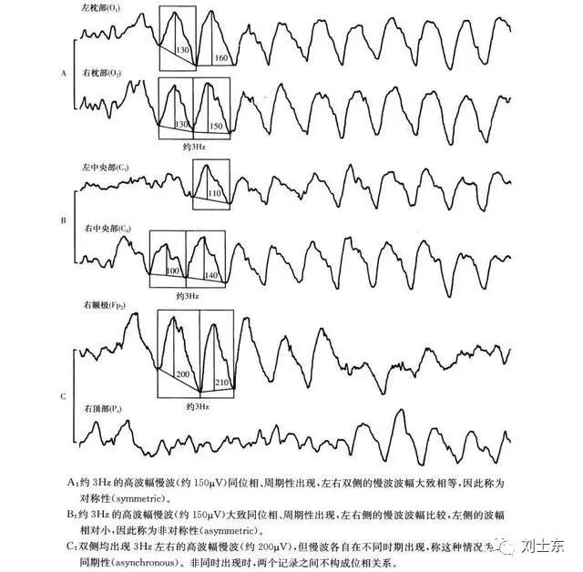 脑电图基础知识入门,脑电图基础知识讲解