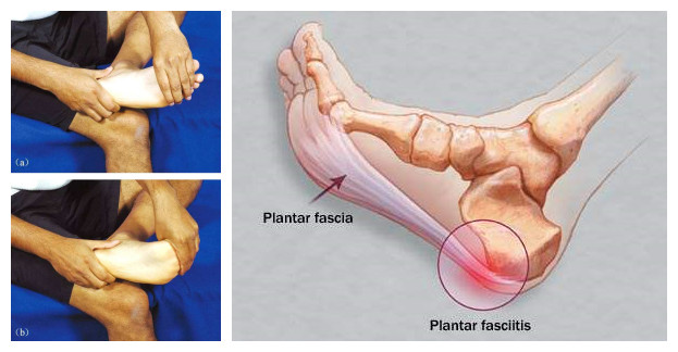 骨刺与跖筋膜炎怎么治疗,足跟痛骨刺与跖筋膜炎