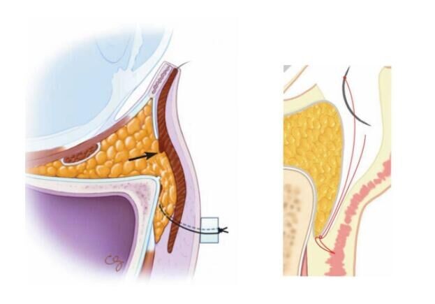 眶隔脂肪释放去眼袋需要多少钱,去眼袋不做眶隔释放可以吗