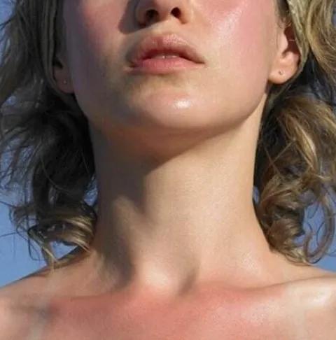 晒完黑了怎么补救,晒了一年变黑了多久能恢复