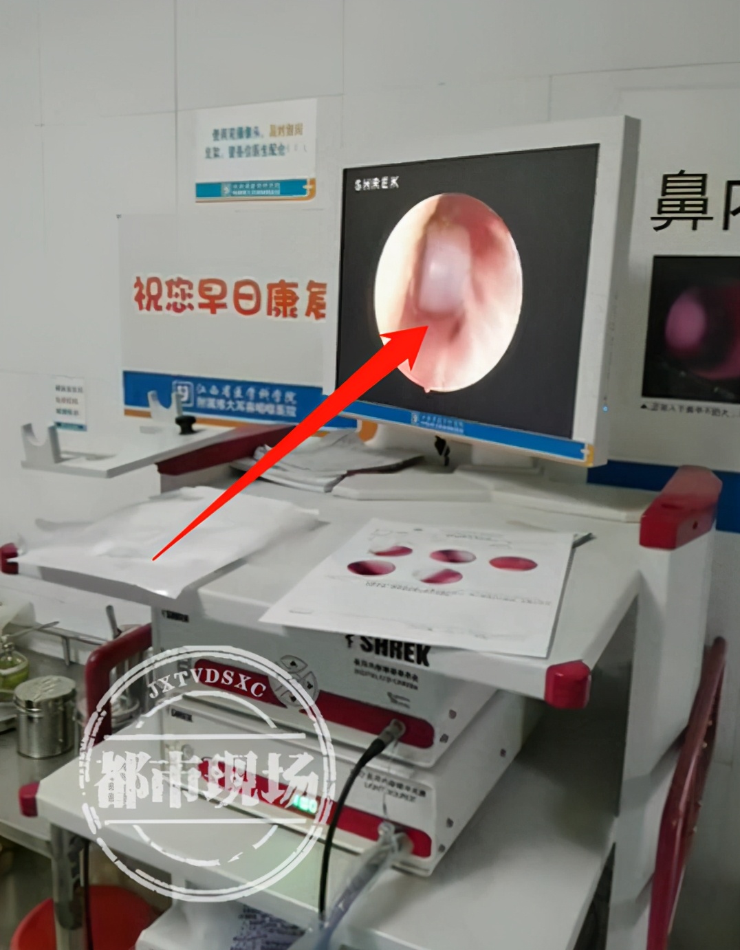 儿童耳朵进异物做手术,儿童耳内塞异物后果