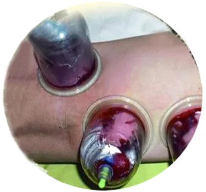 刺络放血排瘀祛湿,刺络放血疗法后怎么消炎