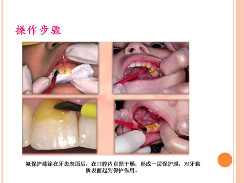 牙齿涂氟小知识,有氟牙可以涂氟吗