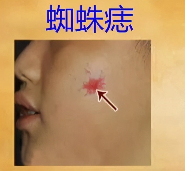 专升本体检谷草转氨酶高会被刷吗,公务员体检谷草转氨酶44能过吗