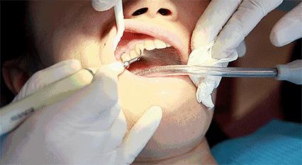 牙齿一个大洞露出牙神经还能补吗,为什么牙齿有一个洞不疼