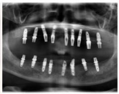 满口缺牙如何补牙,满口缺牙怎么办
